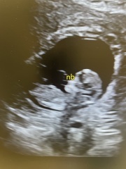 11 week scan - nub theory 