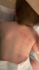 Heat rash or ?
