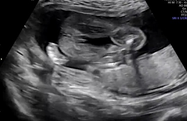 Has anyone been told the gender of a baby at a scan?
