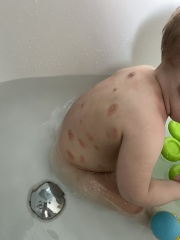 Is this even eczema?! Photo attached!