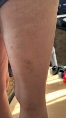 Unexplained vaginal bleeding and bruises