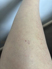 Is this heat rash?!