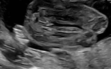 Has anyone been told the gender of a baby at a scan?