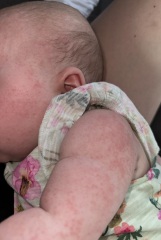 Baby rash