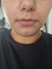 Dry skin around mouth and nose pics attached - what could be causing it?
