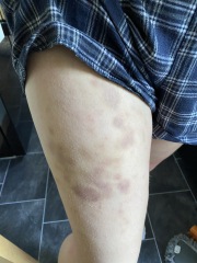 Advice on itchy skin and bruising