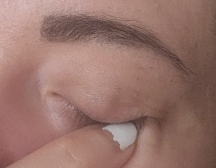 Eyelid bump - **pictures**