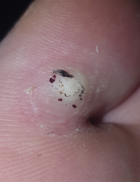 Is this a verruca still?? Picture attached