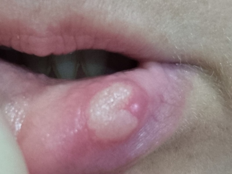 To ask what I can do with this huge ulcer (pic)