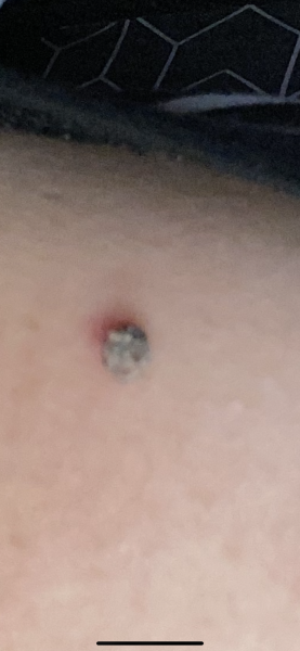 Skin tag has turned black - can I remove it myself ?