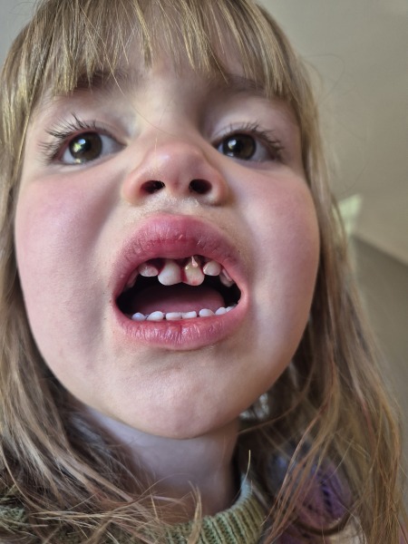 3 year old damaged front 2 teeth after a fall