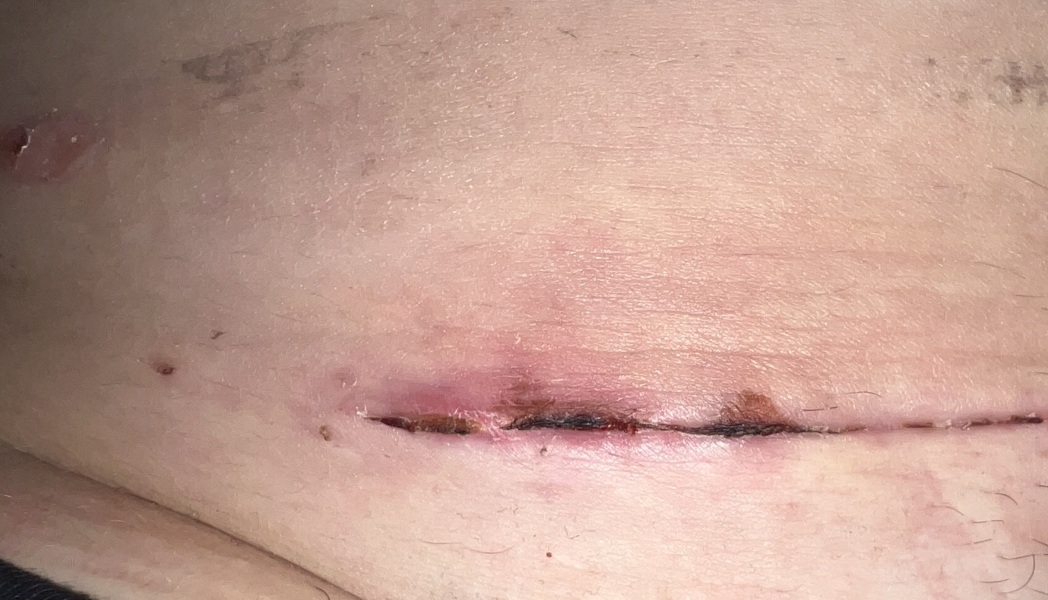 C section recovery after birth