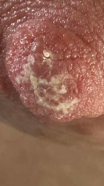 Sore nipples. NIPPLE PHOTO