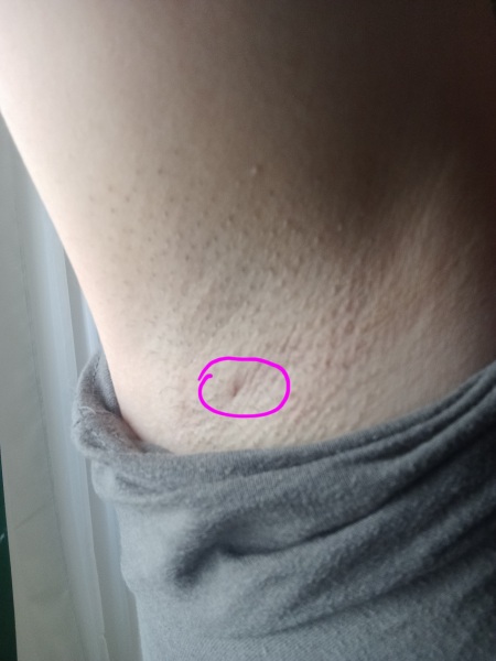 Armpit ingrown hair?