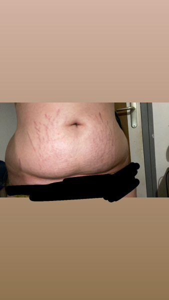 loose skin (help)