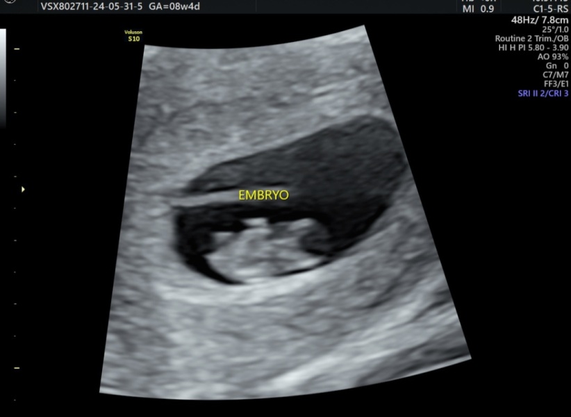8 week abdominal scan - do I flip it?