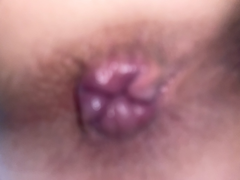 Is this piles? TW picture