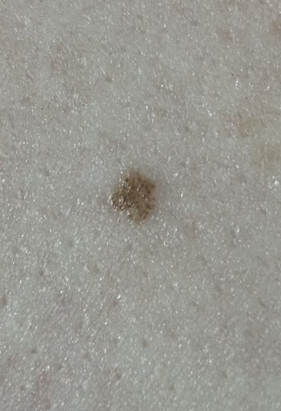 What do you think of this mole?