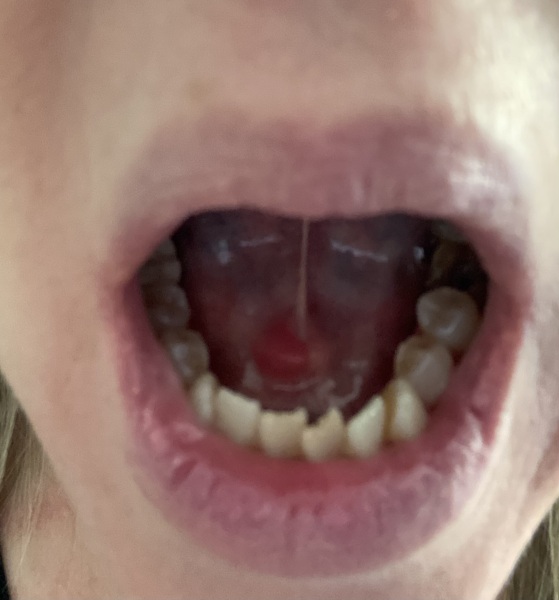 Lump on floor of mouth
