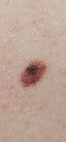 Changed mole