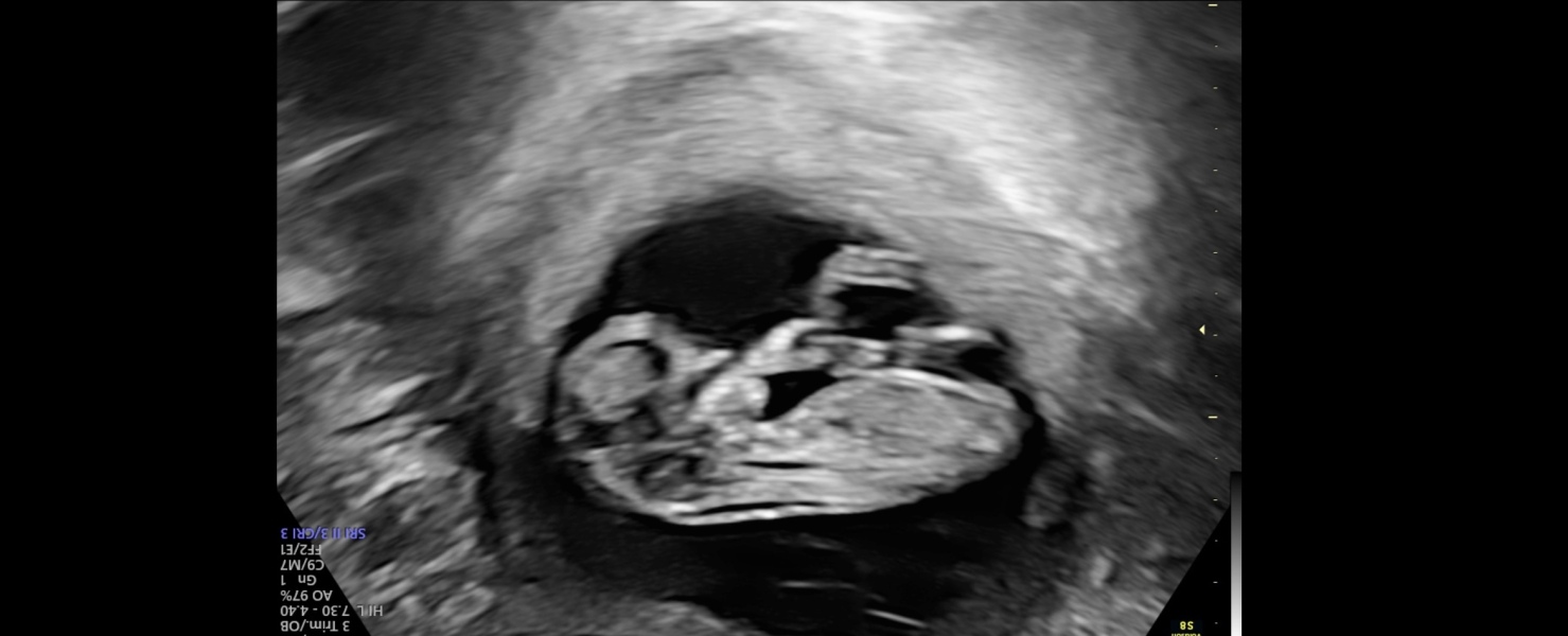 Gender guess scan at 12 weeks