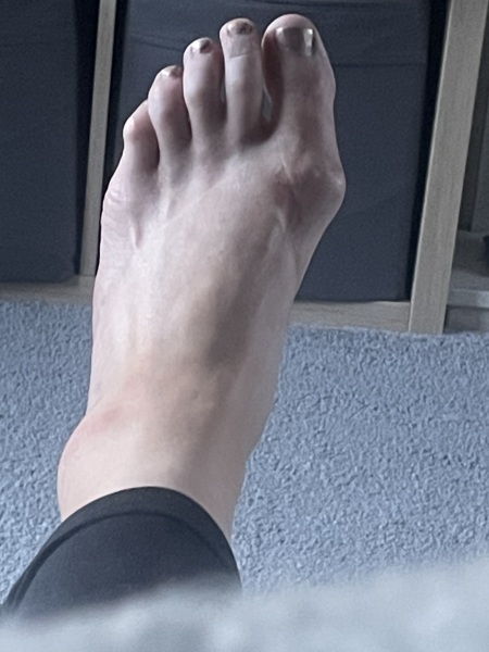 How can I stop this bunion getting worse? (Photo)