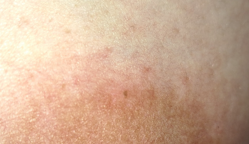 Freckle on areola