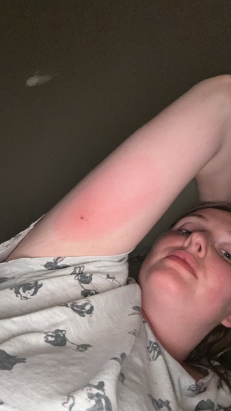 Bite with red patch?