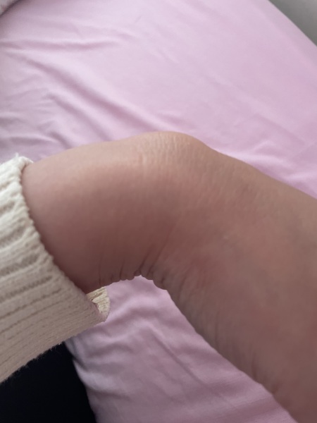 Lump on wrist
