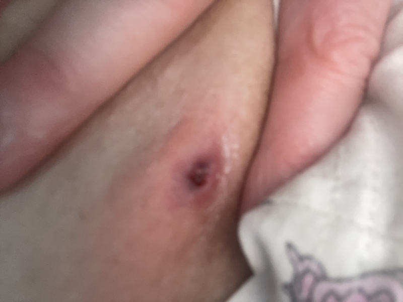 Painful lump in groin area