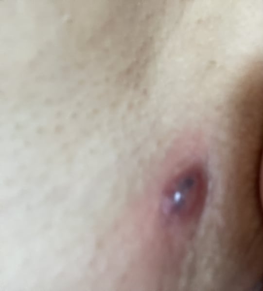 Painful lump in groin area