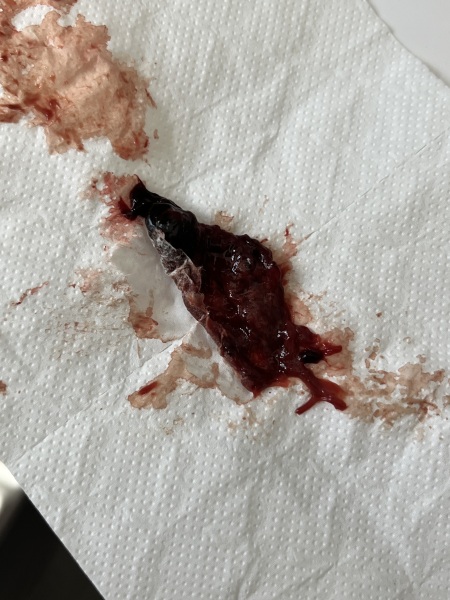 Postpartum blood clots/tissue - TMI pic warning