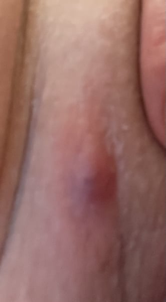 Painful lump in groin area