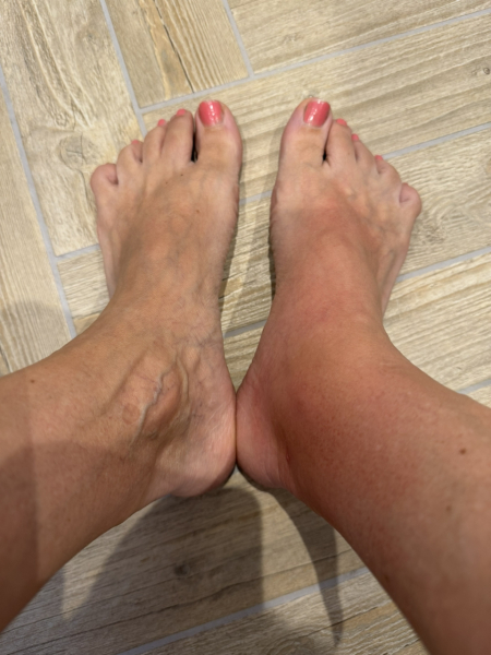 My skin massively overreacts to mosquito bites