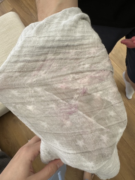 Omeprazole - purple sick?