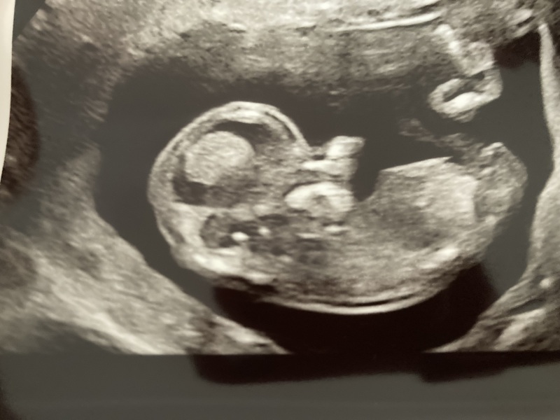 12 week scan but can’t see nub
