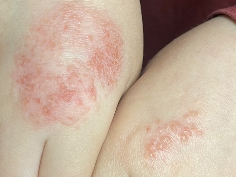 What’s this rash/skin issue?