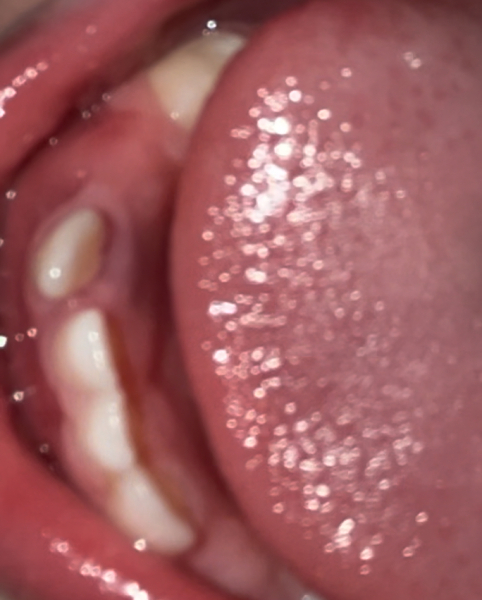 Milk tooth injury
