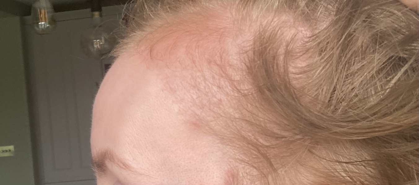 I’ve just had a hair transplant AMA