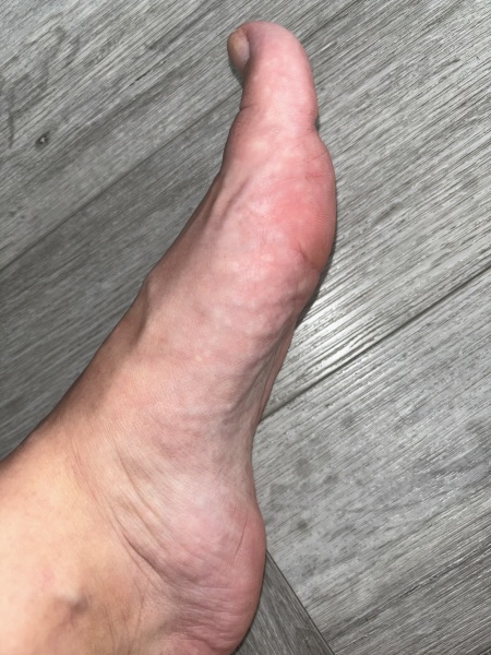 blotchy rash on palm of hands/soles of feet