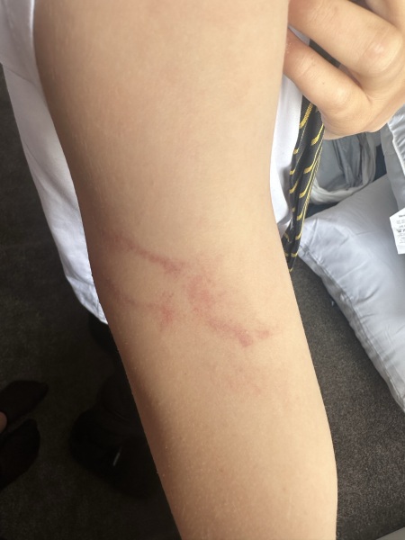 Red marks / lines on arm