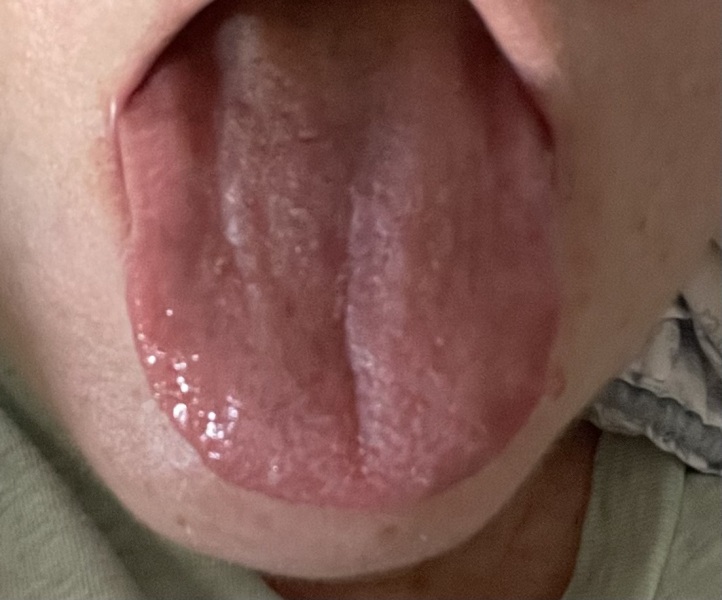 What is my tongue indicating??
