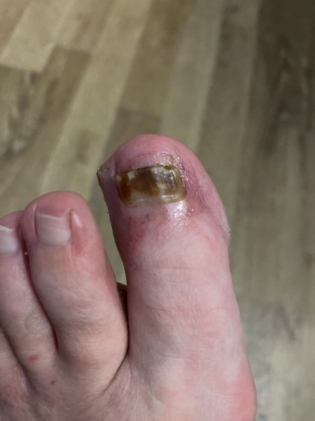 Accountability thread - disgusting toe nails includes photos
