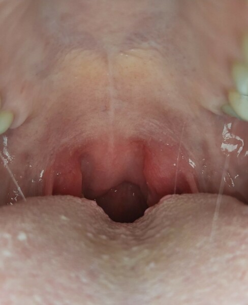 Tonsillitis? Photo attached!