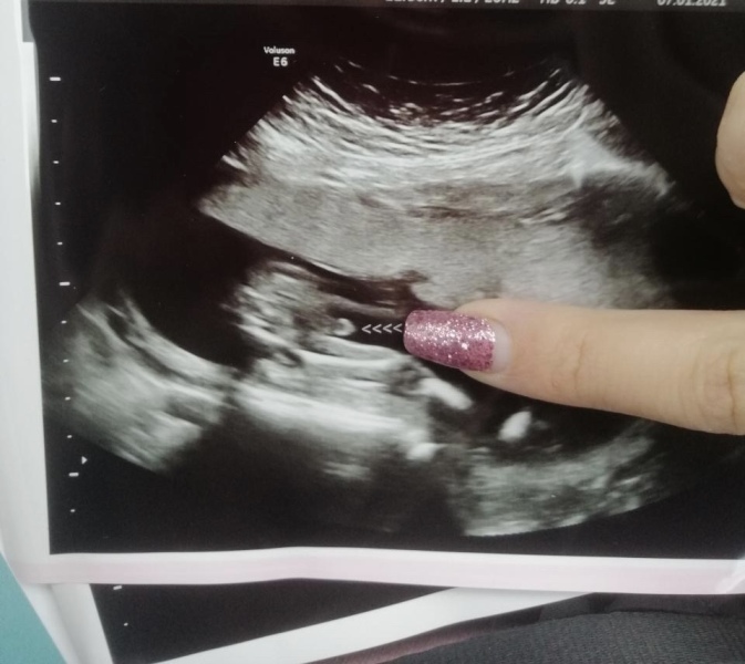 Potty shot @ 15 weeks, is it a boy???