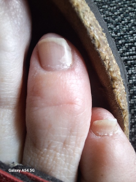 Broken toenail fix for wedding guest!!