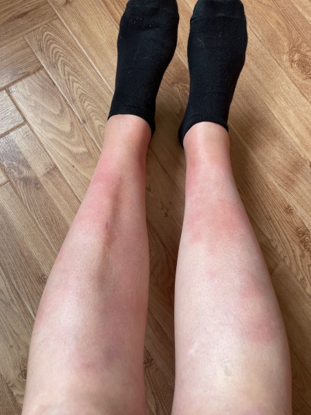 Erythema Nodosum