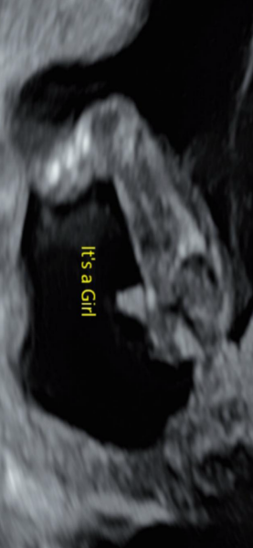 Gender scan guesses