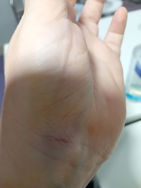Bruised hand