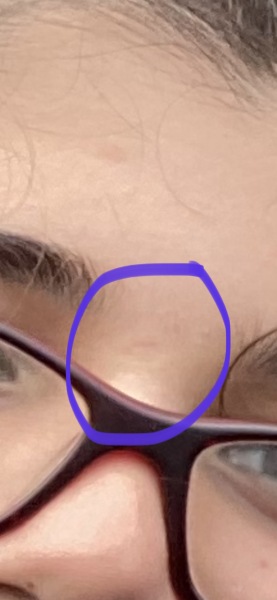 Chicken pox pock marks- the after scars! 